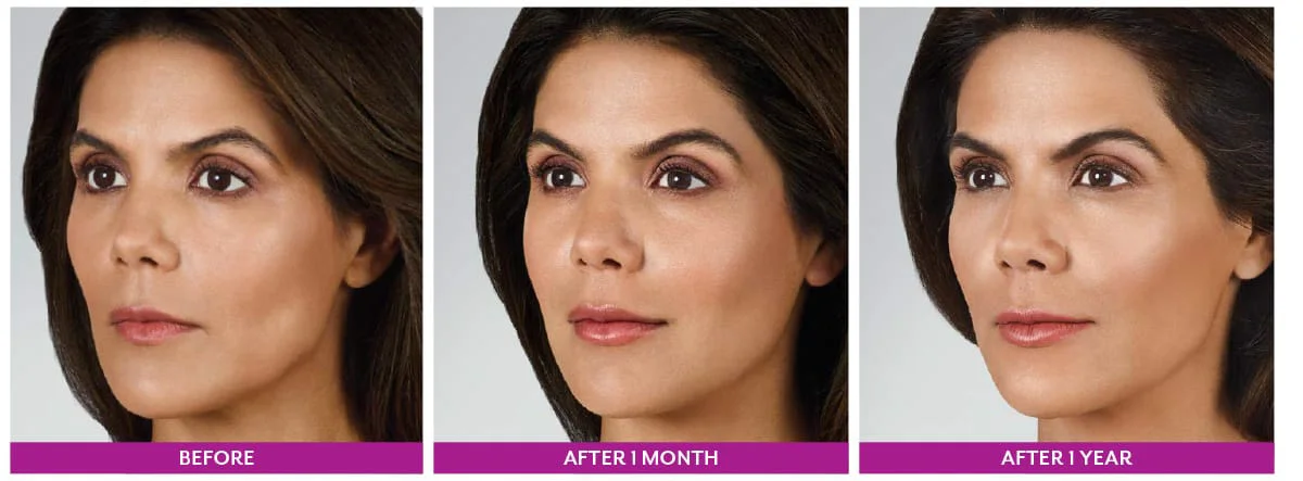 JUVÉDERM lip filler comparison labeled before, after one month, and after one year.