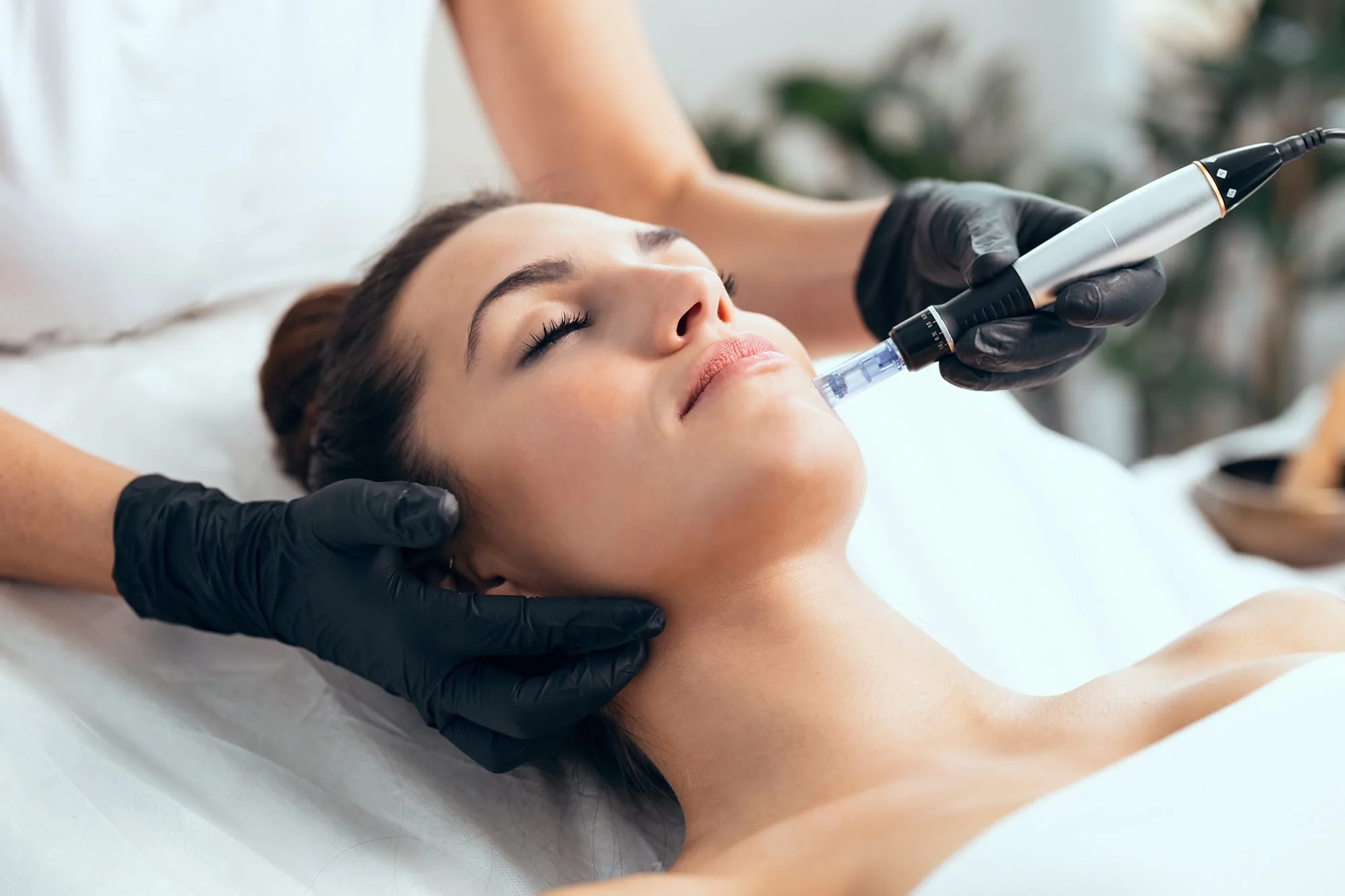 A practitioner applies a microneedling device to the cheek.